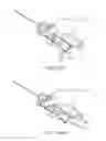 Fig. 41 - Devices and methods for tissue transfer