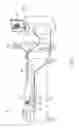 Fig. 02 - Catheter entanglement indication