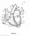 Fig. 02 - Transcoronary sinus pacing system, LV summit pacing, early mitral closure pacing, and methods therefor