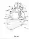 Fig. 03 - Transcoronary sinus pacing system, LV summit pacing, early mitral closure pacing, and methods therefor