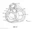 Fig. 04 - Transcoronary sinus pacing system, LV summit pacing, early mitral closure pacing, and methods therefor