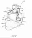 Fig. 05 - Transcoronary sinus pacing system, LV summit pacing, early mitral closure pacing, and methods therefor
