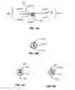 Fig. 08 - Transcoronary sinus pacing system, LV summit pacing, early mitral closure pacing, and methods therefor