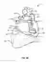 Fig. 14 - Transcoronary sinus pacing system, LV summit pacing, early mitral closure pacing, and methods therefor