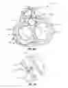 Fig. 17 - Transcoronary sinus pacing system, LV summit pacing, early mitral closure pacing, and methods therefor