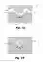 Fig. 13 - Thermoformed electrode arrays