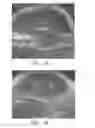 Fig. 03 - Brachytherapy Seed with Fast Dissolving Matrix for Optimal Delivery of Radionuclides to Cancer Tissue