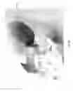 Fig. 07 - Surgical implant