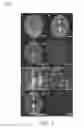 Fig. 08 - MRI using spatially adaptive regularization for image reconstruction