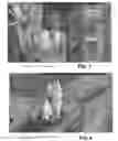 Fig. 03 - Using motion compensated temporal filter (MCTF) statistics for scene change detection when a fade, dissolve or cut occurs