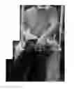 Fig. 04 - Device for facilitating self-dressing