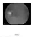 Fig. 16 - Portable corneal topographer