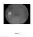 Fig. 16 - Portable wavefront aberrometer with open field alignment channel
