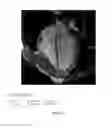 Fig. 03 - METHOD FOR DETERMINING DIASTASIS TIMING USING AN MRI SEPTAL SCOUT