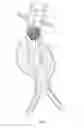 Fig. 03 - Endovascular aneurysm repair system