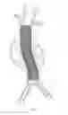 Fig. 04 - Endovascular aneurysm repair system
