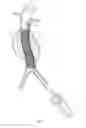 Fig. 09 - Endovascular aneurysm repair system