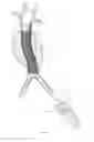 Fig. 10 - Endovascular aneurysm repair system