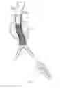 Fig. 12 - Endovascular aneurysm repair system