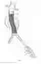 Fig. 14 - Endovascular aneurysm repair system