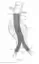 Fig. 20 - Endovascular aneurysm repair system