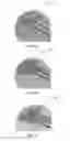 Fig. 07 - BONE REMOVAL UNDER DIRECT VISUALIZATION