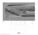 Fig. 13 - BONE REMOVAL UNDER DIRECT VISUALIZATION