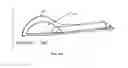 Fig. 20 - BONE REMOVAL UNDER DIRECT VISUALIZATION