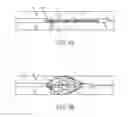 Fig. 03 - Delivery of thrombolytic agent through actuation member of thrombus retrieval device