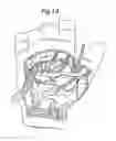 Fig. 02 - VESSEL HARVESTER