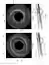 Fig. 13 - Atherectomy catheters and occlusion crossing devices