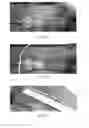 Fig. 16 - Atherectomy catheters and occlusion crossing devices