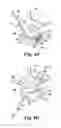 Fig. 10 - Device and method for removing bodily material