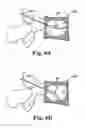 Fig. 12 - Device and method for removing bodily material