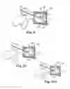 Fig. 13 - Device and method for removing bodily material