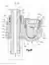 Fig. 05 - Minimally invasive spinal fixation system including vertebral alignment features