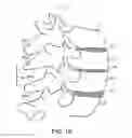 Fig. 03 - SURGICAL TETHER APPARATUS AND METHODS OF USE