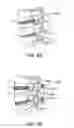 Fig. 09 - SURGICAL TETHER APPARATUS AND METHODS OF USE