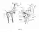 Fig. 06 - Surgical instrument for manipulating, positioning and fixing a surgical rod in relation to an implant