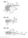 Fig. 05 - Flexible elongated chain implant and method of supporting body tissue with same