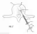 Fig. 03 - Tumor ablation system