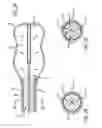 Fig. 04 - Tumor ablation system