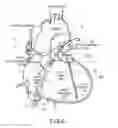 Fig. 09 - BALLOON CATHETER ABLATION SYSTEM