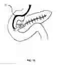 Fig. 17 - ENDO-NAVIGATION SYSTEMS AND METHODS FOR SURGICAL PROCEDURES AND CPR