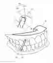 Fig. 01 - CLEAR ALIGNER AND MANUFACTURING METHOD THEREOF, TRACTION DEVICE FOR CLEAR ALIGNER, AND AID FOR TRACTION DEVICE FOR CLEAR ALIGNER
