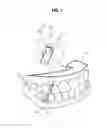 Fig. 02 - CLEAR ALIGNER AND MANUFACTURING METHOD THEREOF, TRACTION DEVICE FOR CLEAR ALIGNER, AND AID FOR TRACTION DEVICE FOR CLEAR ALIGNER