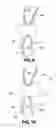 Fig. 06 - Therapeutically contoured, compliance encouraging aligner implement