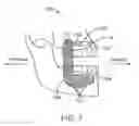 Fig. 08 - Mandibular advancement and retraction via bone anchoring devices