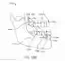 Fig. 15 - Mandibular advancement and retraction via bone anchoring devices