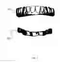 Fig. 02 - Dental implant prosthesis
